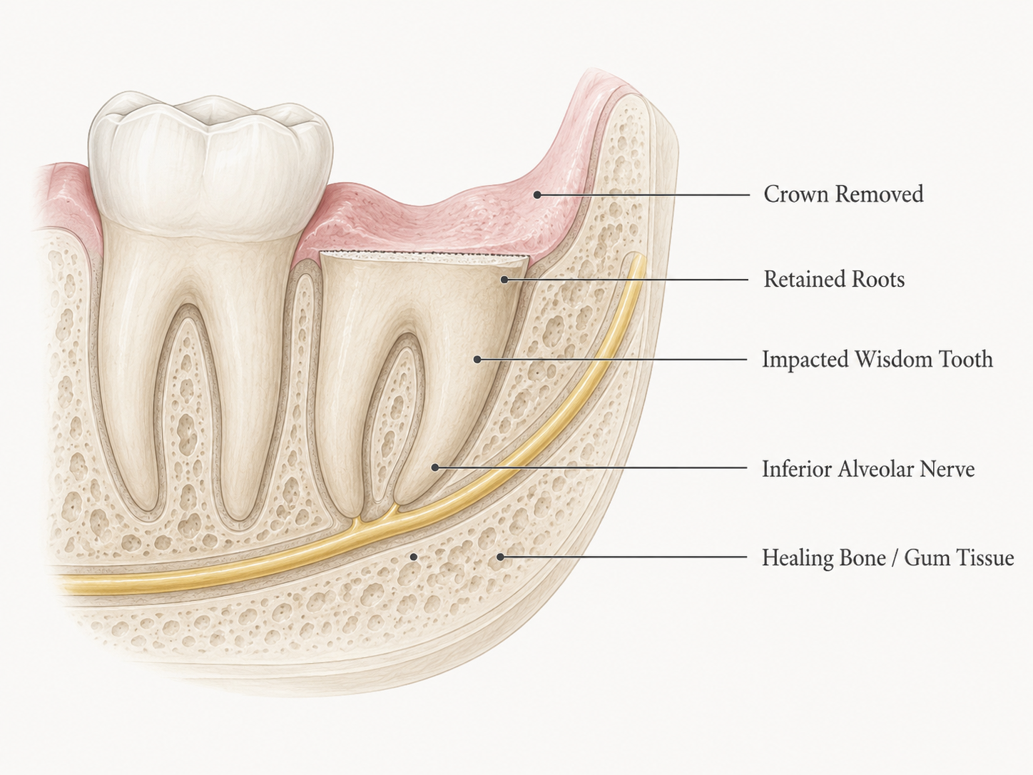 Cross-section diagram of a lower jaw showing a coronectomy: the crown of an impacted wisdom tooth has been removed and the roots retained above the inferior alveolar nerve, with labels for crown removed, retained roots, impacted wisdom tooth, inferior alveolar nerve, and healing bone and gum tissue.