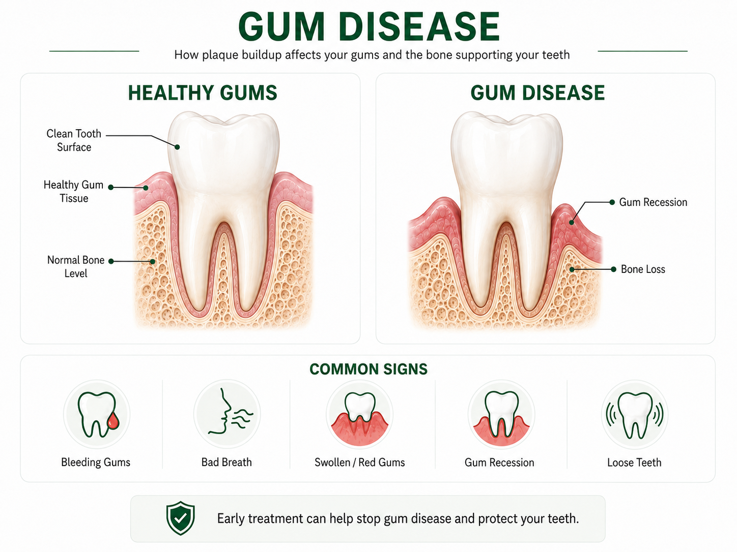 Infographic comparing healthy gums, with a clean tooth surface, healthy gum tissue and normal bone level, against gum disease, showing gum recession and bone loss. Also lists common signs: bleeding gums, bad breath, swollen or red gums, gum recession, and loose teeth.